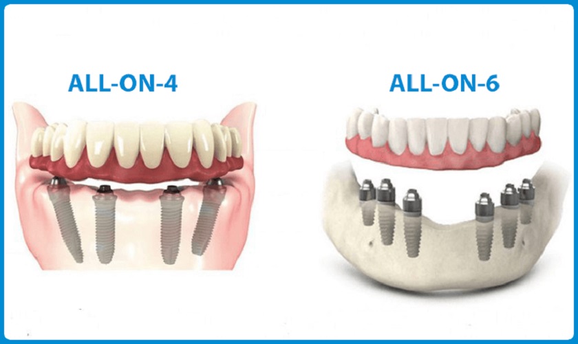 Implant MIS C1 phù hợp để khôi phục răng toàn hàm với phương pháp Implant All On 4, All On 6