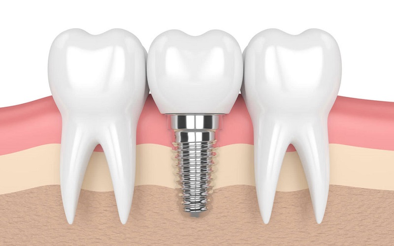 Bác sĩ khuyên khách hàng trồng răng implant sau phẫu thuật?