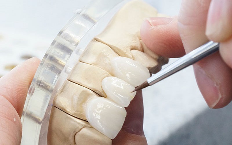 Công nghệ chế tạo răng sứ CAD/CAM và những điều bạn cần biết
