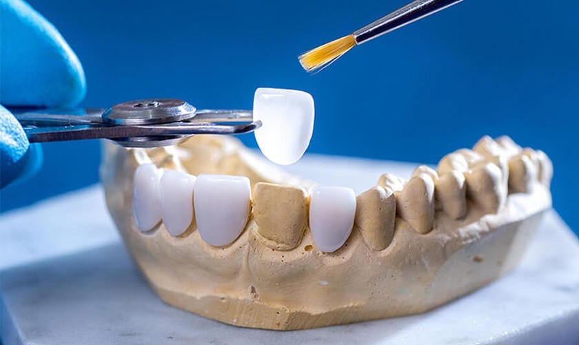 Công nghệ chế tạo răng sứ CAD/CAM đem đến độ chính xác cao