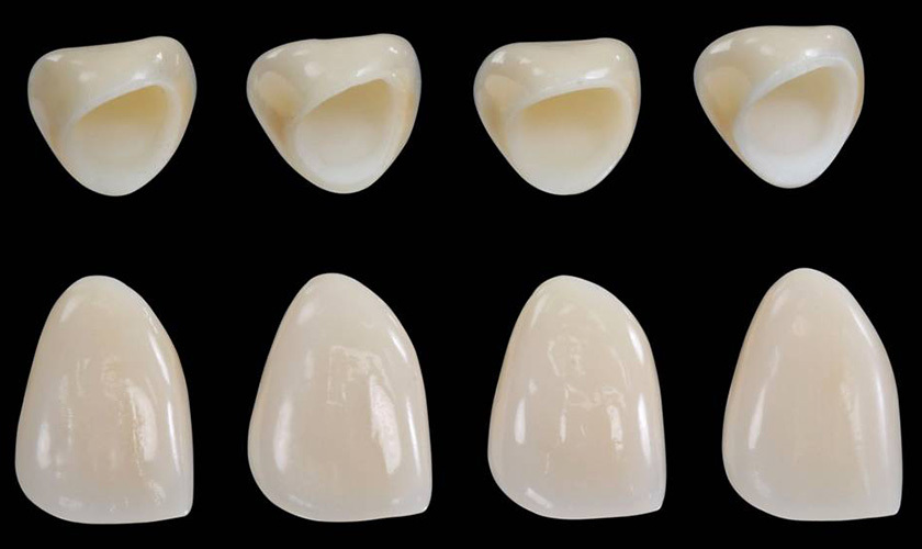 Công nghệ chế tạo CAD/CAM cho ra những chiếc răng sứ cân đối và hài hòa