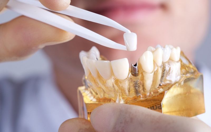 Top 8 địa chỉ trồng răng Implant tại TPHCM