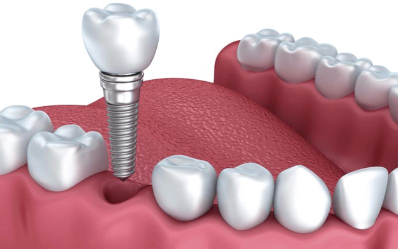 Dịch vụ cấy ghép răng implant chất lượng hàng đầu TP.HCM