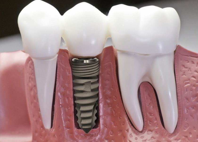 Trồng răng implant là biện pháp để thay thế các răng đã mất