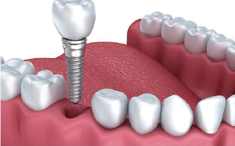 Điều kiện trồng răng implant bạn nên biết