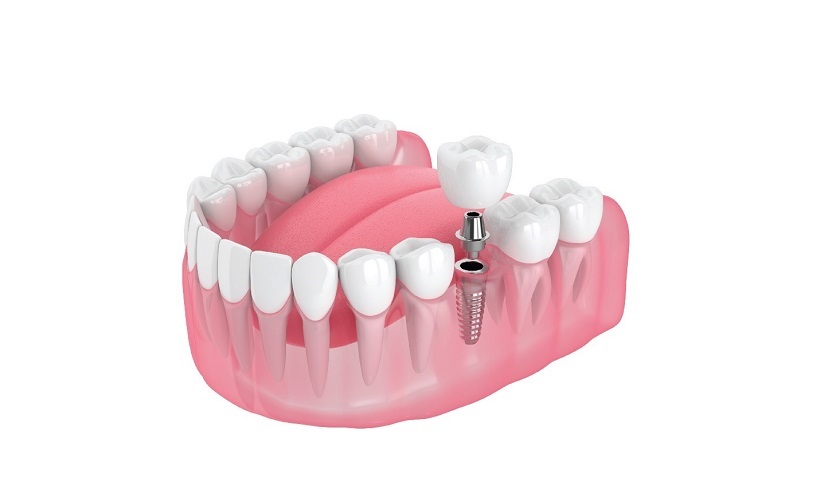 Trồng răng implant phù hợp với đa số trường hợp mất răng