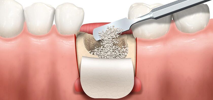 Xương ổ răng và xương hàm phải vững chắc để đặt implant không gặp trở ngại