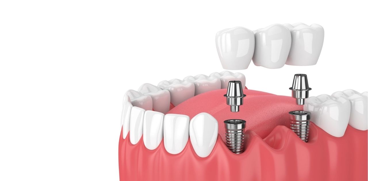 Gắn răng Implant ở đâu an toàn và uy tín nhất hiện nay?