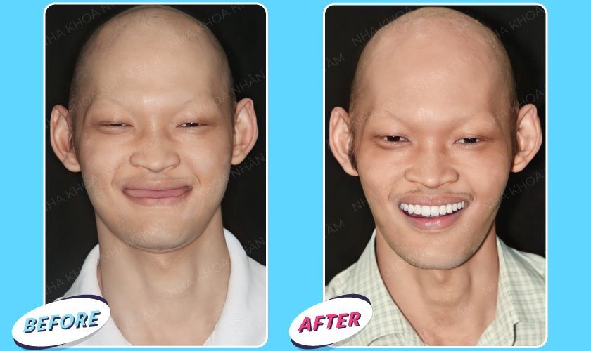 Hình ảnh bệnh nhân trước và sau khi phẫu thuật