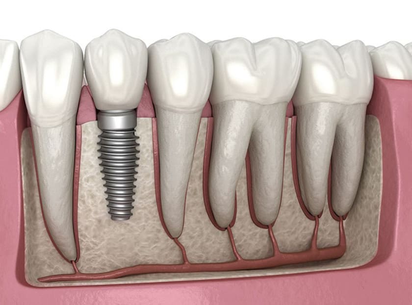 Nên phục hình răng giả càng sớm càng tốt để tránh tình trạng tiêu xương hàm