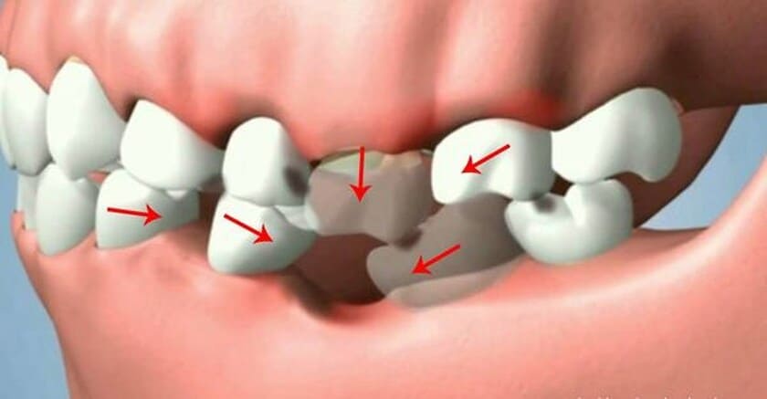 Răng số 6 là răng hàm quan trọng chịu trách nhiệm cắn và nhai thức ăn