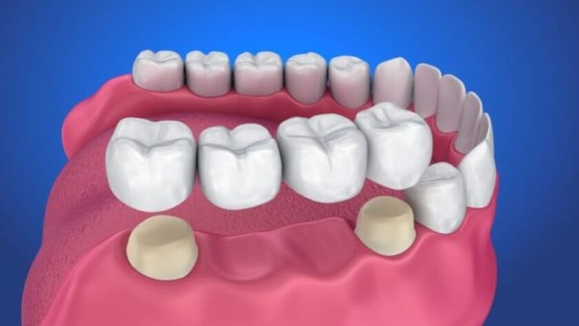 Cầu răng sứ có thể giúp bạn khắc phục tình trạng mất răng