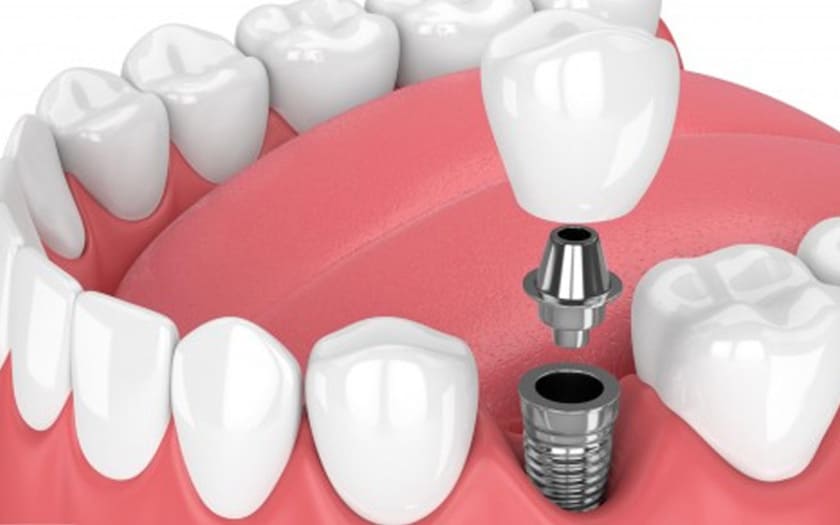 Phương pháp trồng răng implant giúp phục hình răng đã mất một cách hoàn hảo