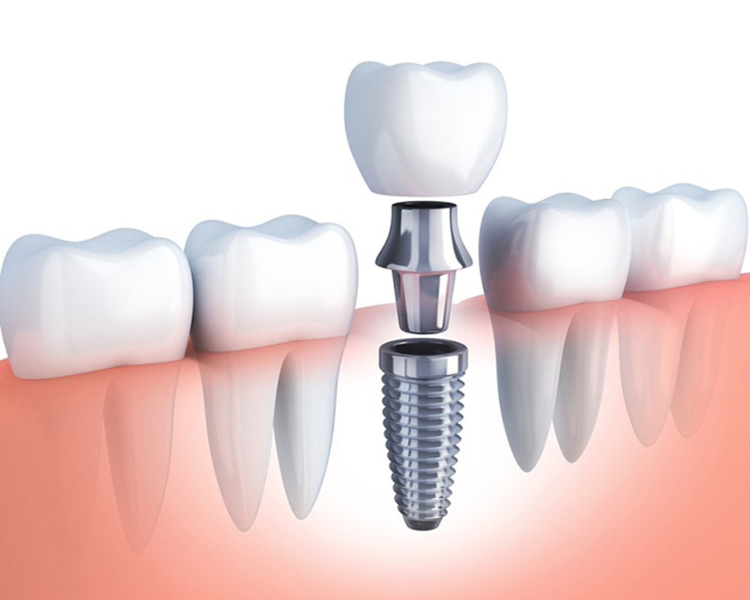 Cấy ghép implant được coi là phương pháp phục hình răng hiện đại nhất hiện nay