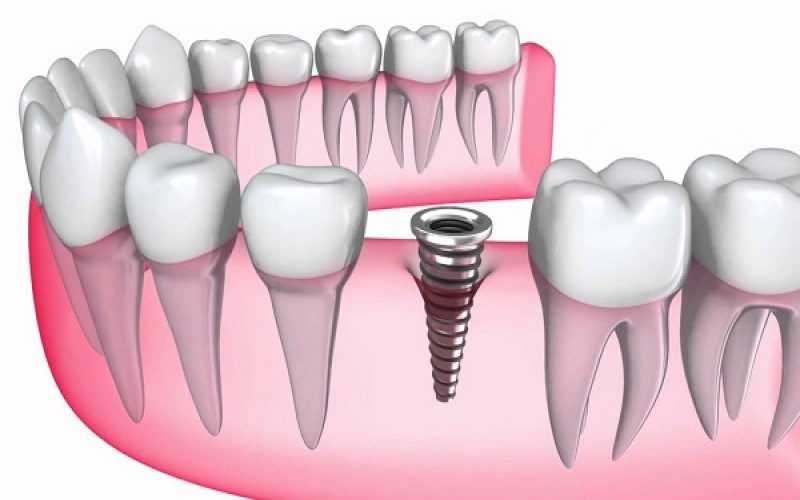 Tiếc nuối khi trồng răng implant quá trễ
