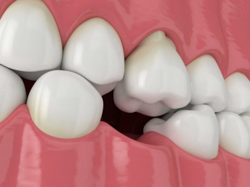 Sự mất cân đối giữa các răng khiến các răng bên cạnh xô lệch