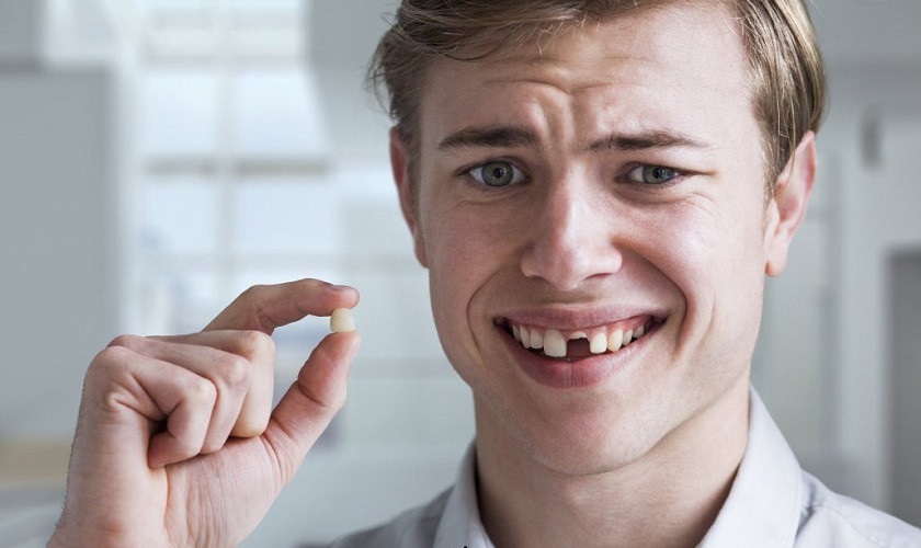 Giải đáp trồng răng cửa hàm trên giá bao nhiêu?