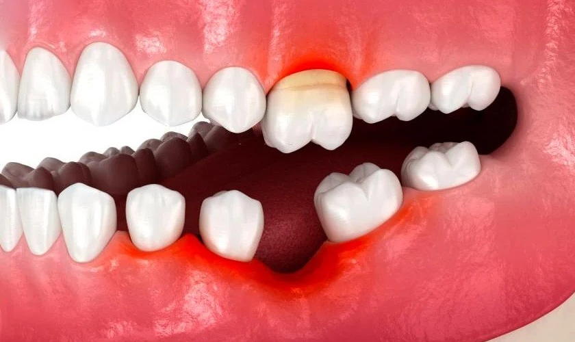 Mất răng có thể gây xô lệch hàm răng