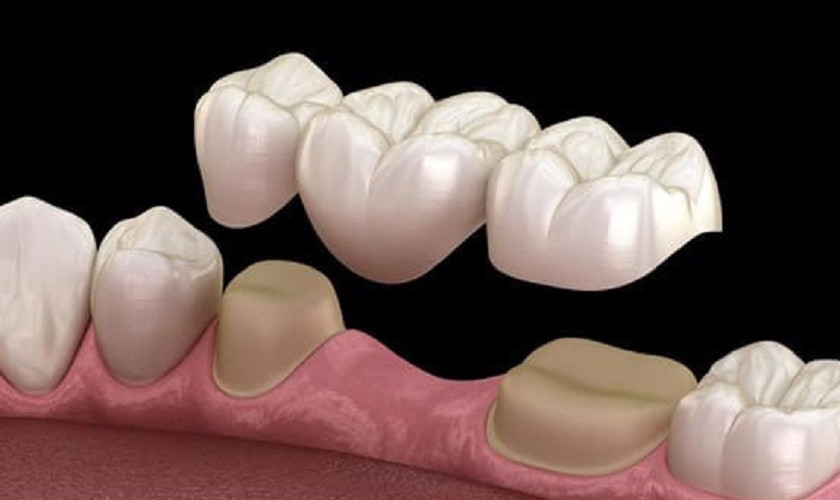 Cầu răng sứ giúp bạn tự tin với nụ cười rạng rỡ