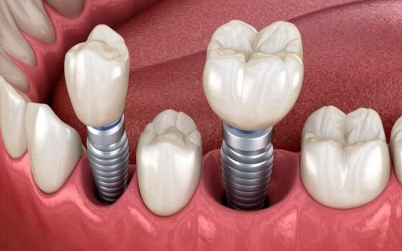Tìm hiểu kỹ thuật trồng răng Implant chịu lực tức thời