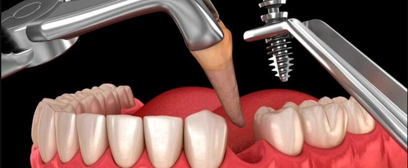 Trồng răng Implant chịu lực tức thời là phục hình mão sứ chính thức ngay sau khi cấy trụ implant