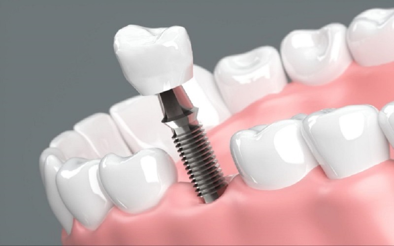 Trồng răng implant có ảnh hưởng gì không?