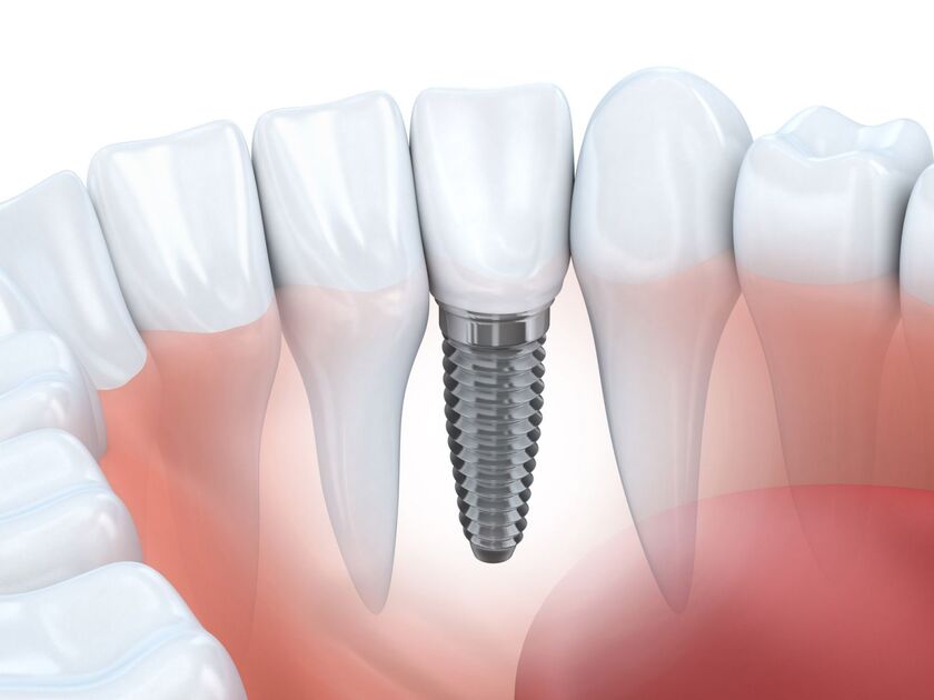 Trồng răng implant khá an toàn và không gây nguy hiểm
