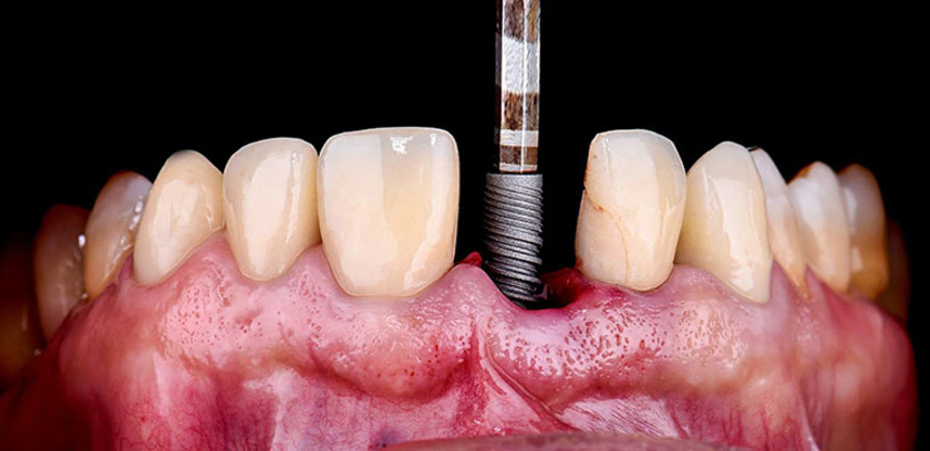 Để trồng răng implant đầu tiên bệnh nhân phải đáp ứng điều kiện sức khỏe