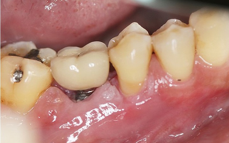 [Giải đáp] Trồng răng implant có biến chứng không?