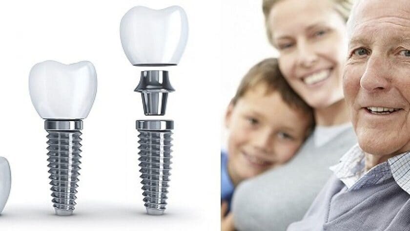 Trồng răng implant cho người già là giải pháp tối ưu được ưa chuộng hiện nay