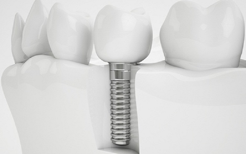 Có nên trồng răng implant số 7 không?
