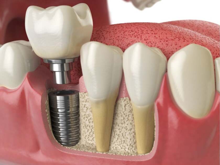 Trồng răng implant số 7 mang đến nhiều lợi ích thiết thực