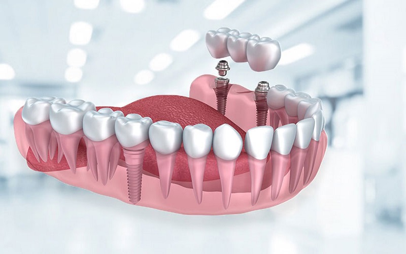 Trồng răng implant trọn gói bao nhiêu tiền?