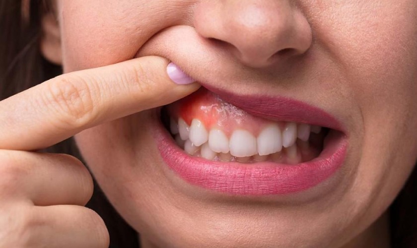 Cách giảm đau khi bị sưng nướu răng tại nhà và tại nha khoa