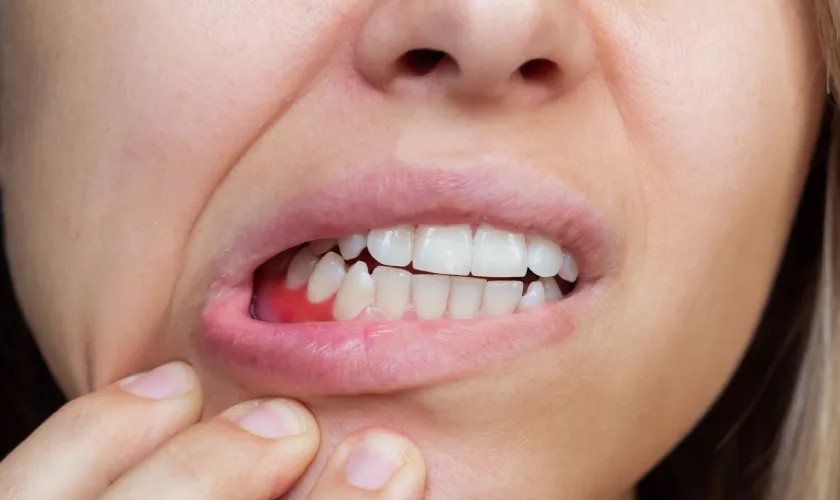 Top 10 cách trị sưng nướu răng tại nhà nhanh, dễ thực hiện