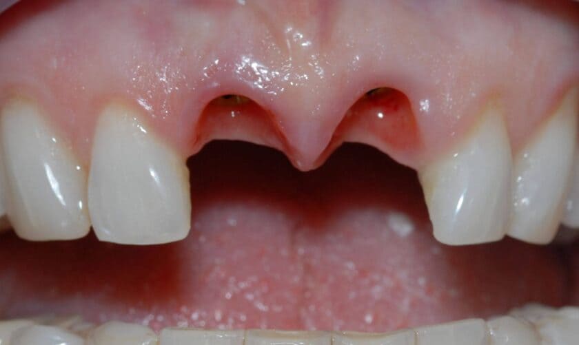 Tình trạng của khách hàng cũng ảnh hưởng đến thời gian trồng răng Implant