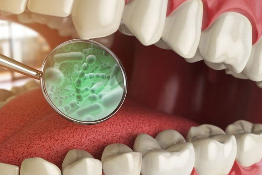 Ngăn ngừa tình trạng sâu răng hiệu quả nhất