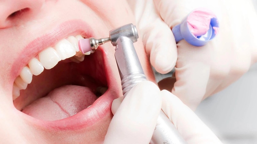 Vật liệu BioHPP có thể dễ dàng xử lý ngay trong khoang miệng