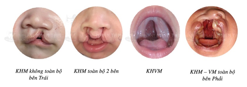 Các dị tật về hàm mặt có thể do yếu tố di truyền