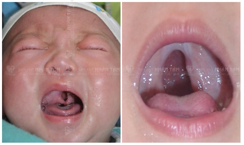 Nguyên nhân và phương pháp điều trị khe hở vòm họng ở trẻ
