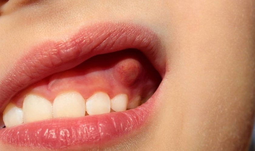 Dấu hiệu nhận biết trẻ bị sưng mộng răng