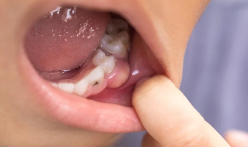 Sưng mộng răng ảnh hưởng đến đời sống của trẻ