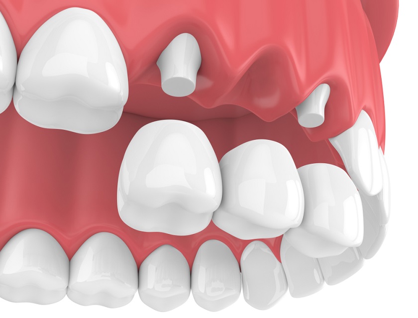 Kỹ thuật phục hình răng đã mất bằng cầu răng sứ
