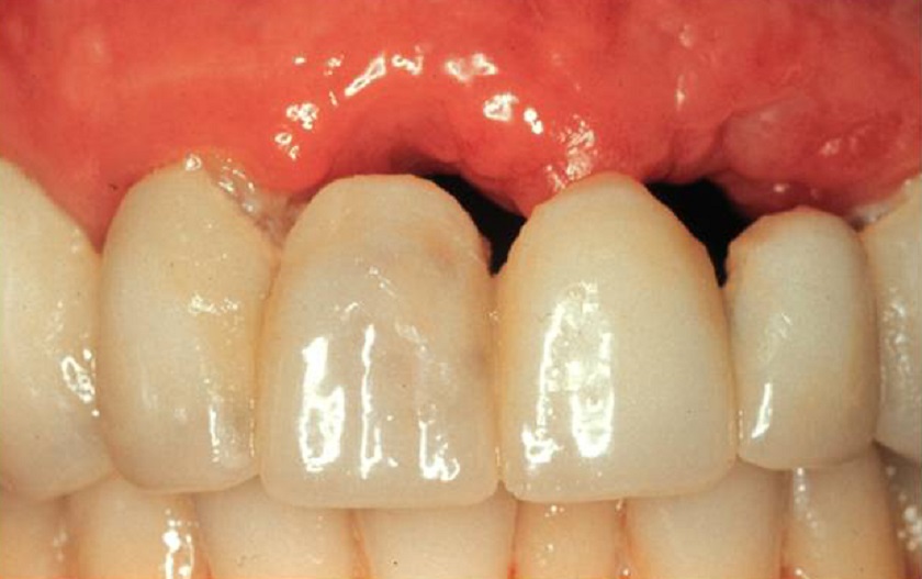 Tình trạng tiêu xương, tụt lợi sau một thời gian dài sử dụng cầu răng sứ