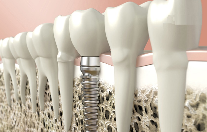 Cấy ghép răng Implant giúp ngăn chặn hôi miệng sau khi phục hình răng giả