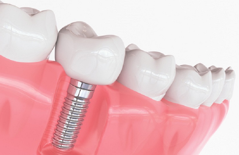 Vì sao Implant được coi là trồng răng vĩnh viễn?