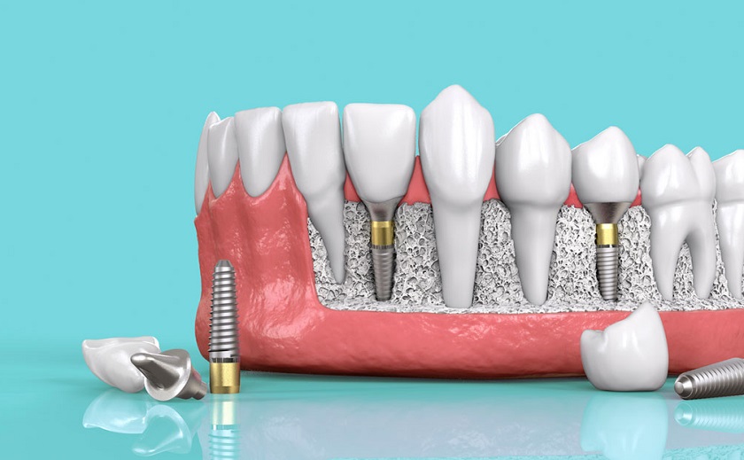 Trồng răng Implant có thể áp dụng để phục hình răng ở tất cả các vị trí