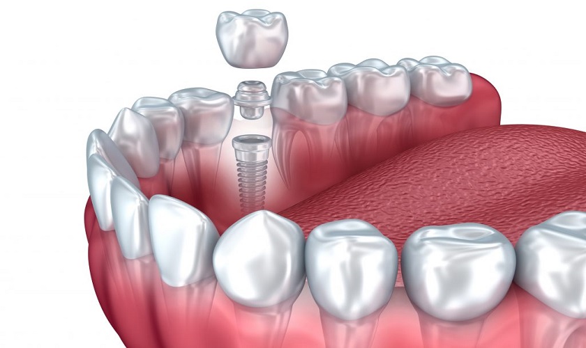 Trồng răng Implant bảo hành tại trung tâm Implant Việt Nam