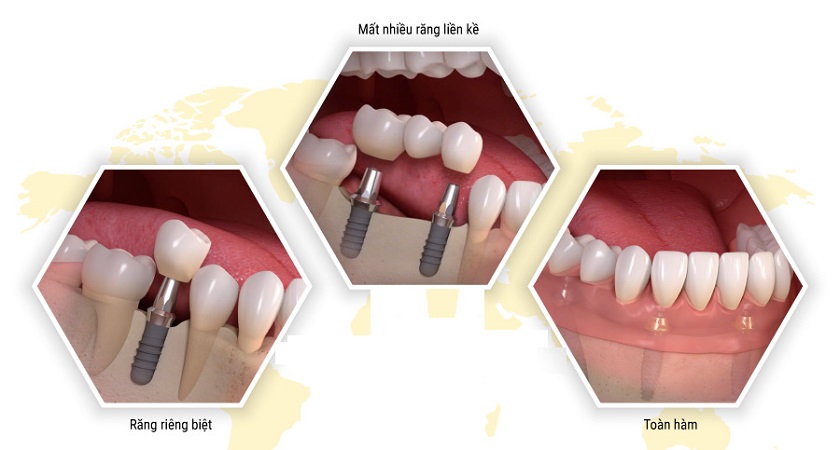 Implant Brat có thể ứng dụng trong nhiều tình huống mất răng