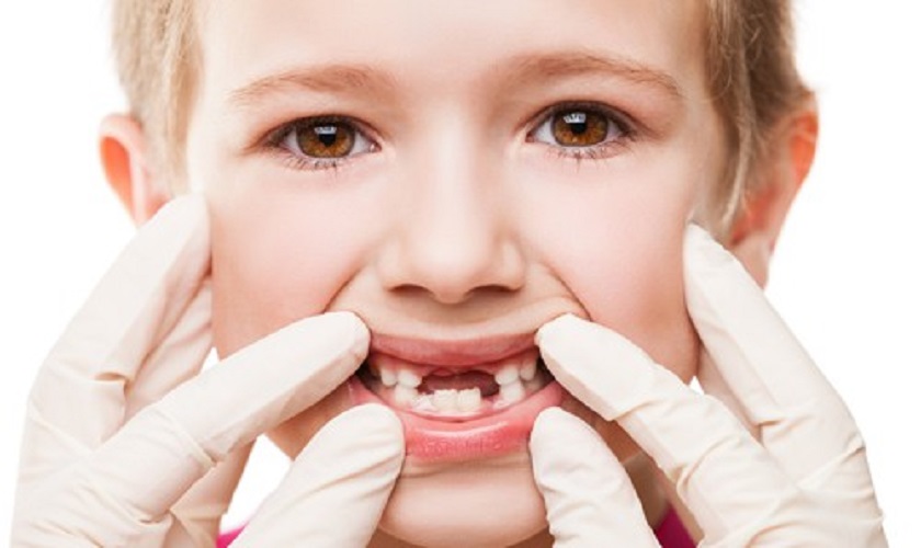 Không nên trồng răng Implant cho trẻ em dưới tuổi trưởng thành
